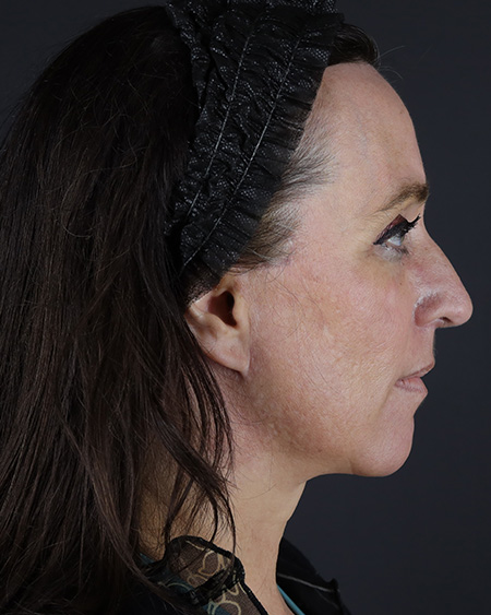 Facelift Before & After Image