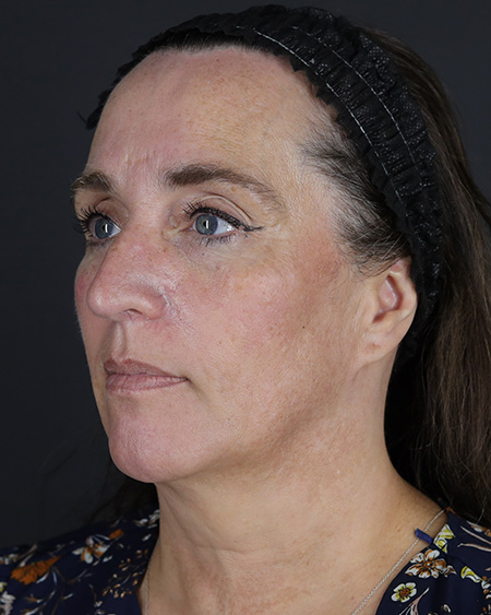 Facelift Before & After Image