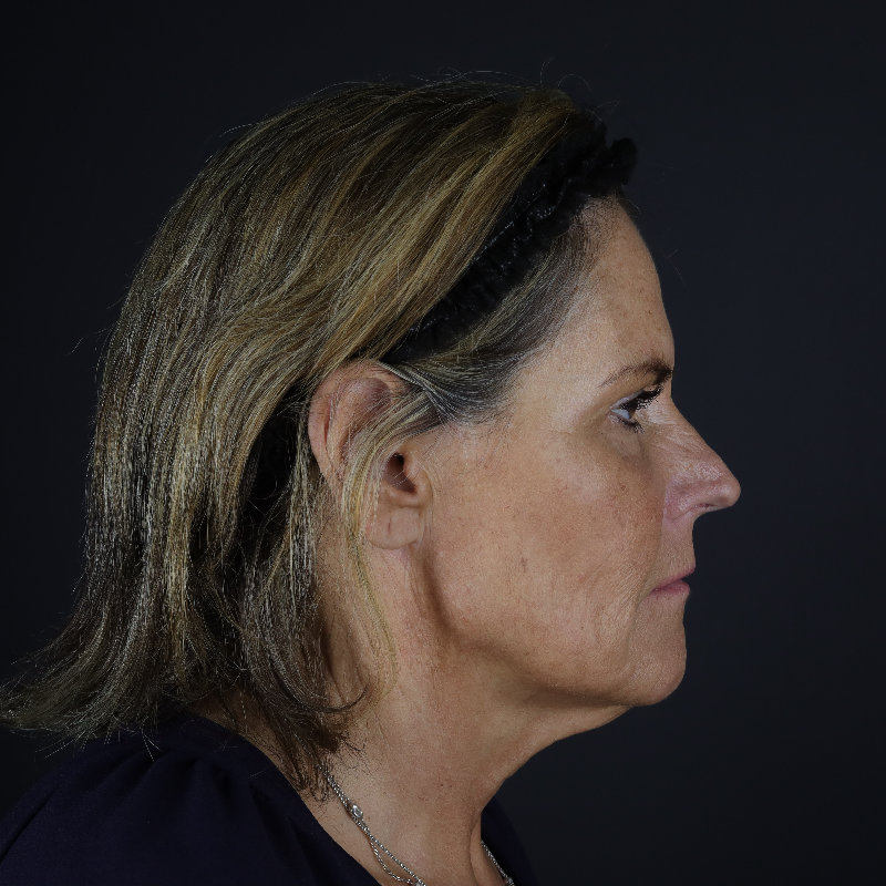 Facelift Before & After Image