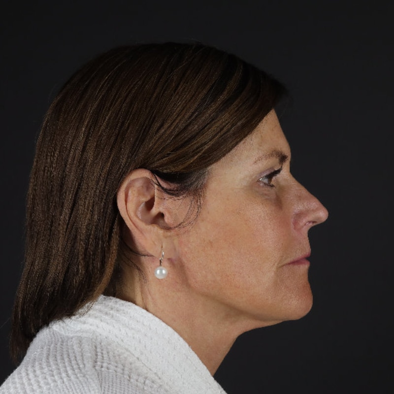 Facelift Before & After Image