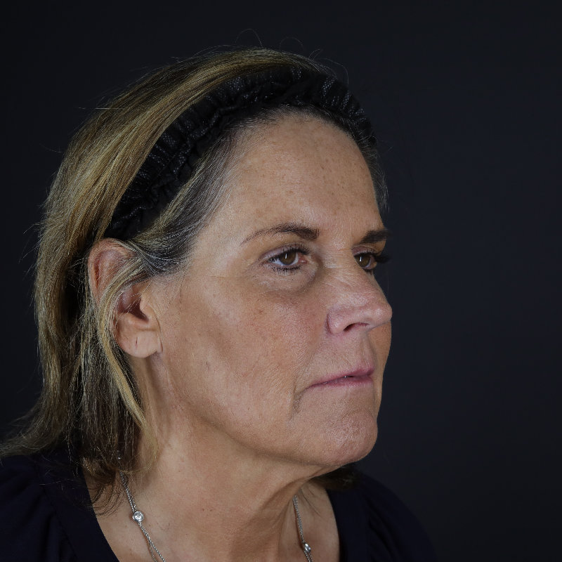 Facelift Before & After Image