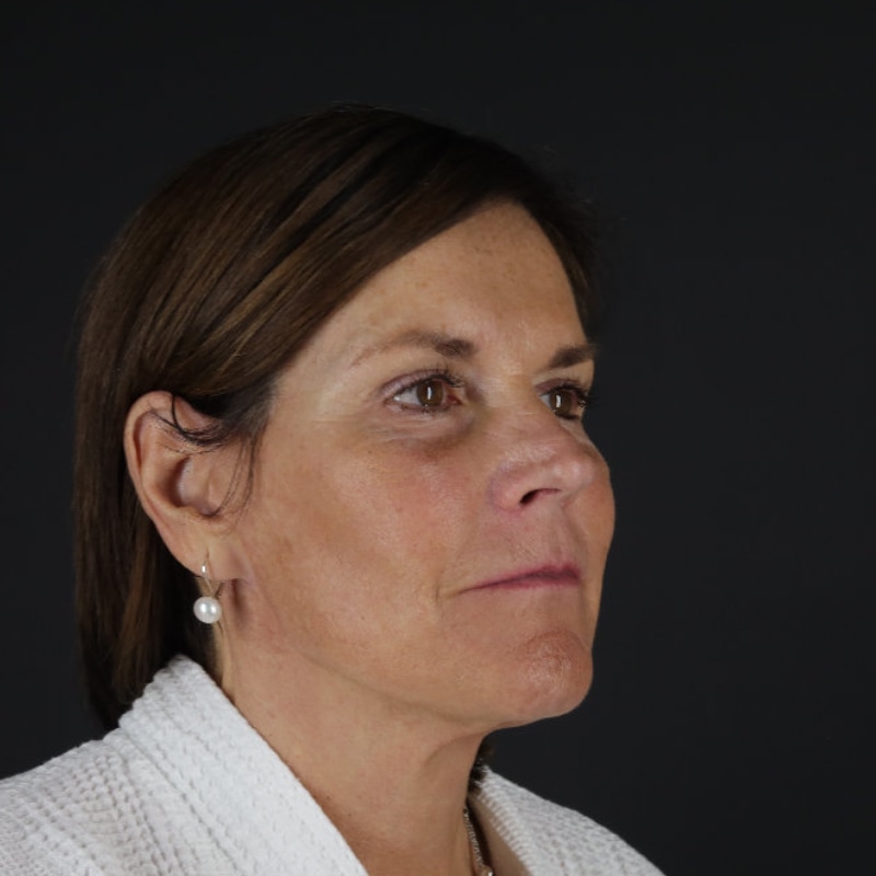 Facelift Before & After Image