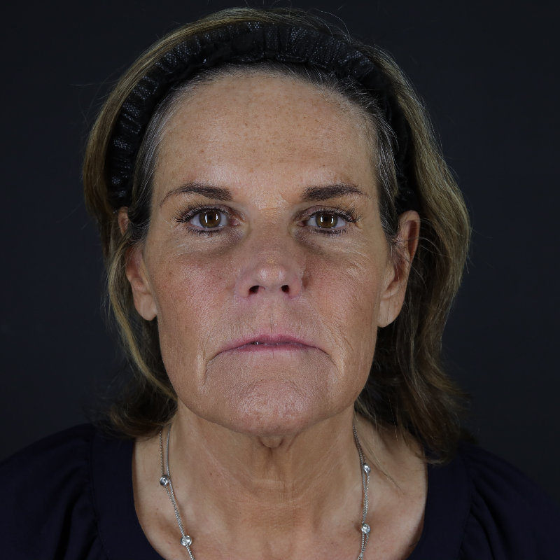 Facelift Before & After Image