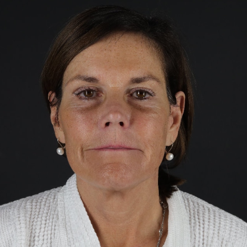 Facelift Before & After Image