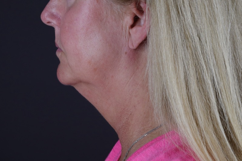 Facelift Before & After Image