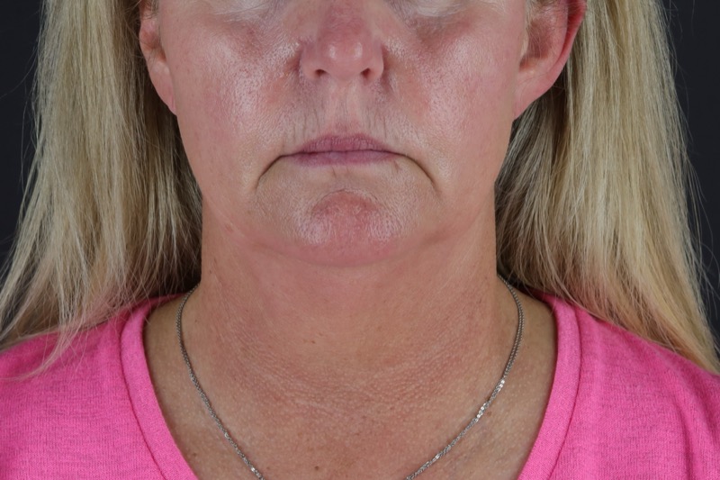 Facelift Before & After Image
