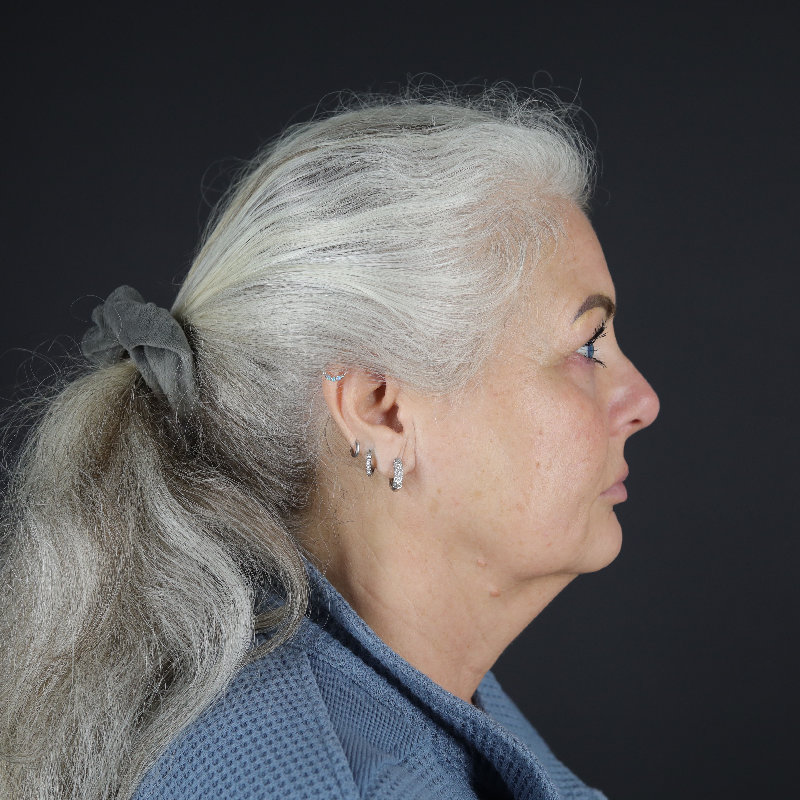 Facelift Before & After Image