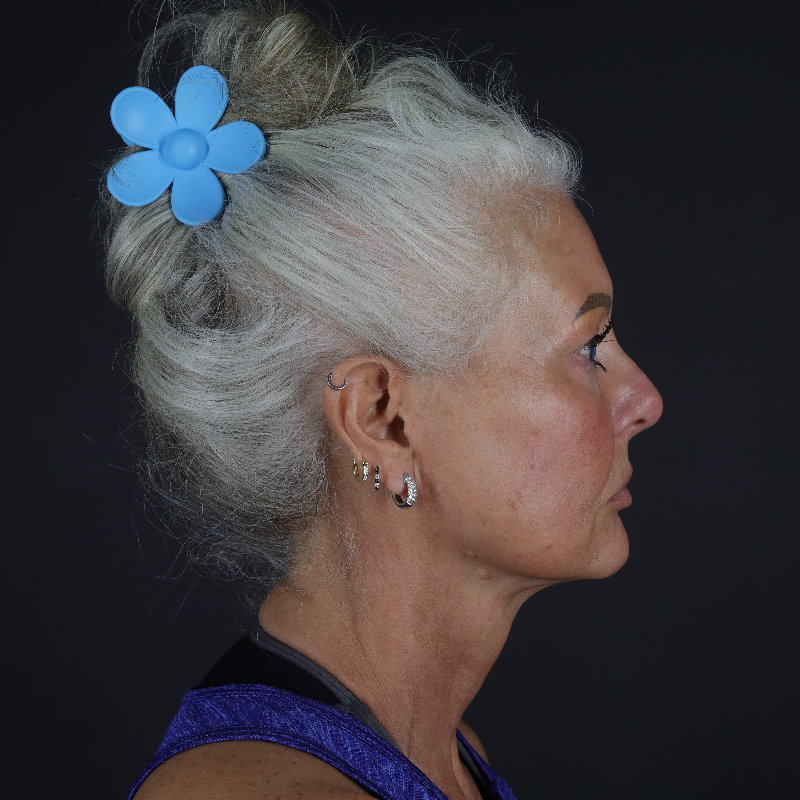 Facelift Before & After Image