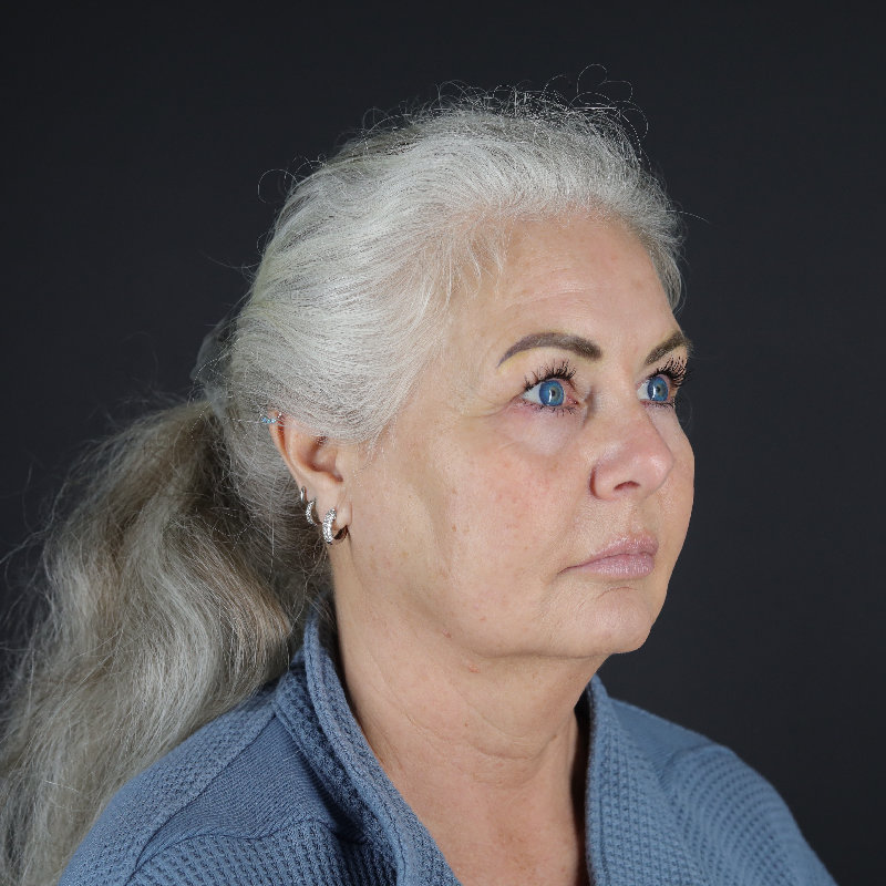 Facelift Before & After Image