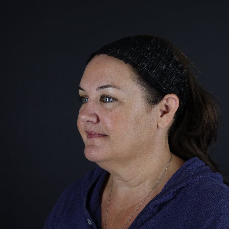 Facelift Before & After Image