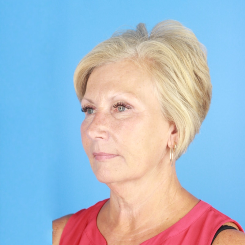 Facelift Before & After Image