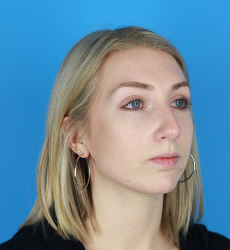 Rhinoplasty Before & After Image